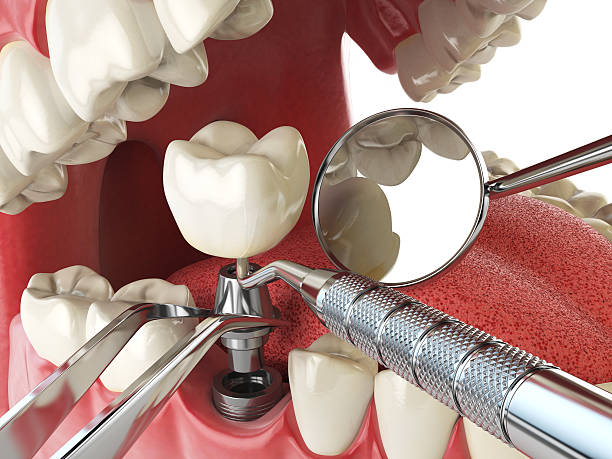 Best Emergency Treatment for Dental Infections or Abscesses in Roebuck, SC